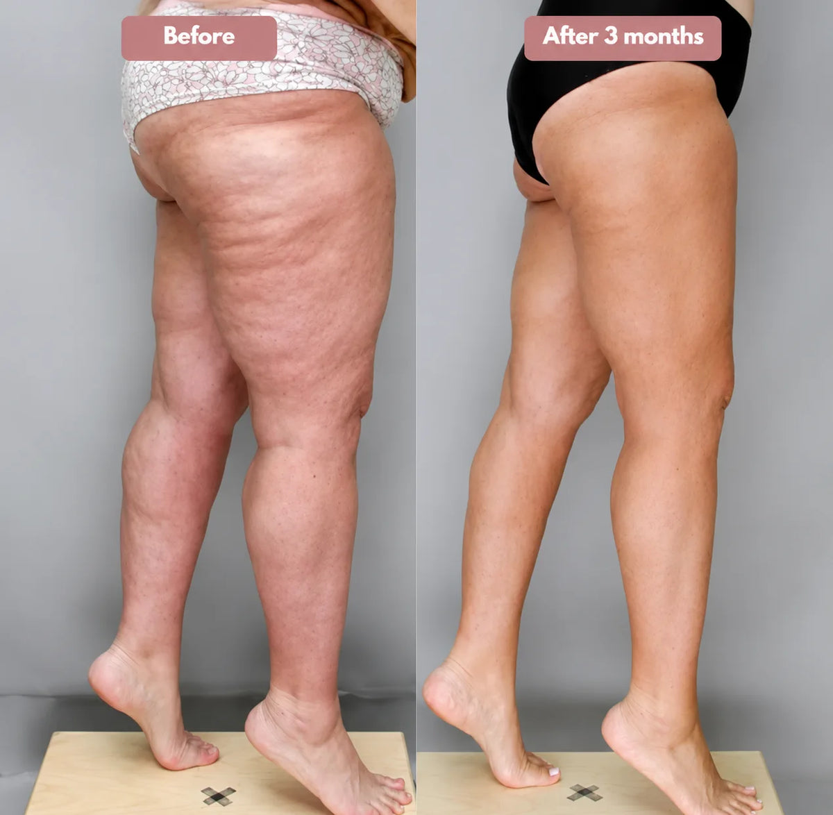 Cellumove 3D Legging – Say goodbye to lipoedema pain and swelling naturally