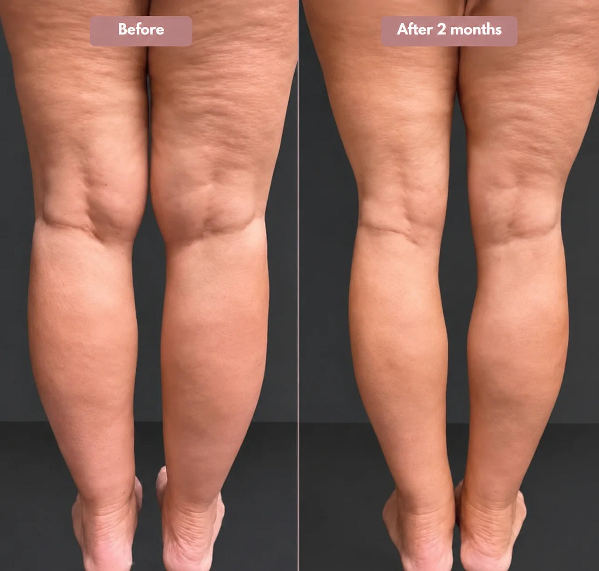Cellumove 3D Legging – Say goodbye to lipoedema pain and swelling naturally
