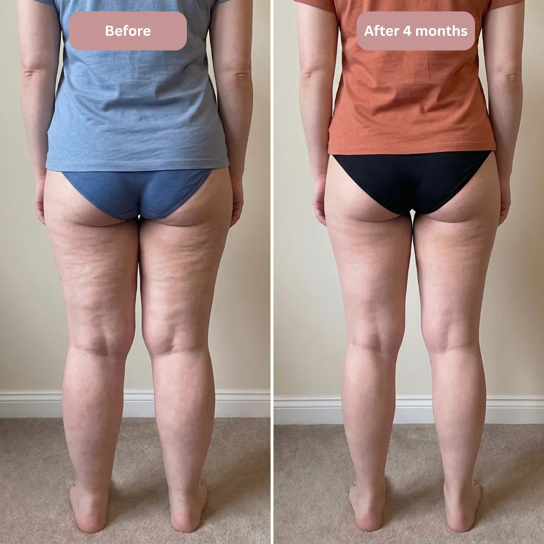 Cellumove 3D Legging – Say goodbye to lipoedema pain and swelling naturally