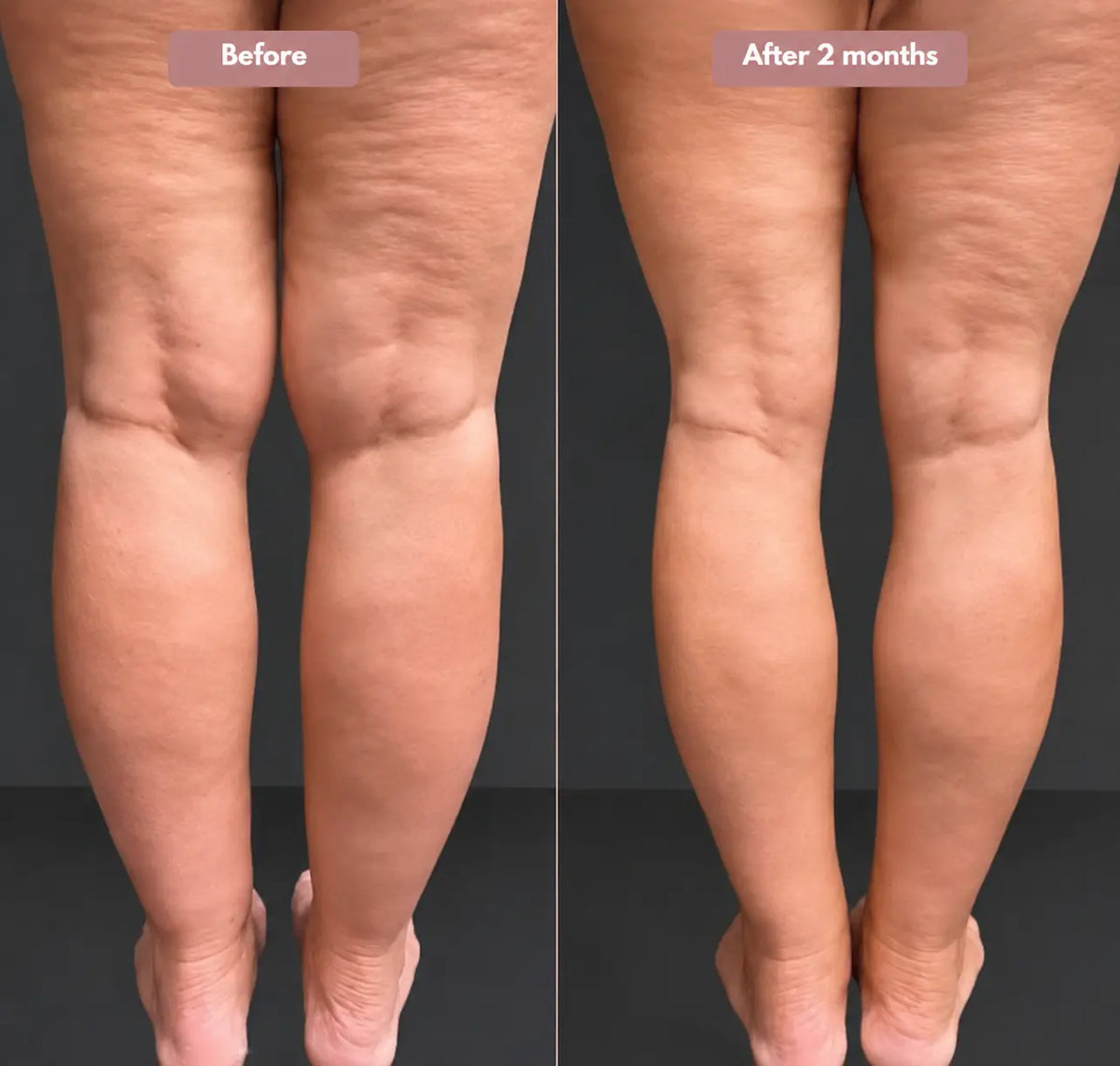 Cellumove 3D Legging – Say goodbye to lipoedema pain and swelling naturally