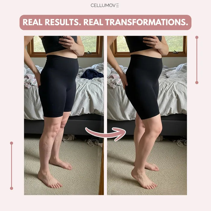 Cellumove 3D Legging – Post partum Edema