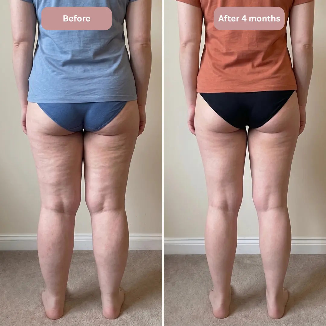 Cellumove 3D Legging – Say goodbye to lipoedema pain and swelling naturally.