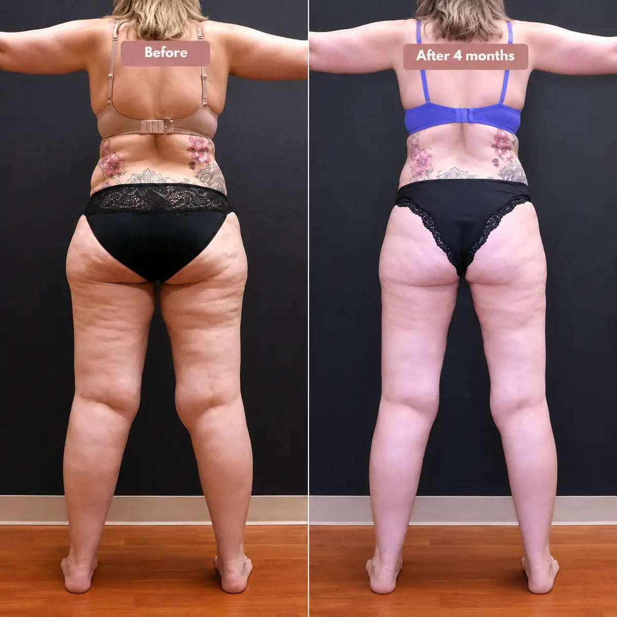 Cellumove 3D Legging – Say goodbye to lipoedema pain and swelling naturally